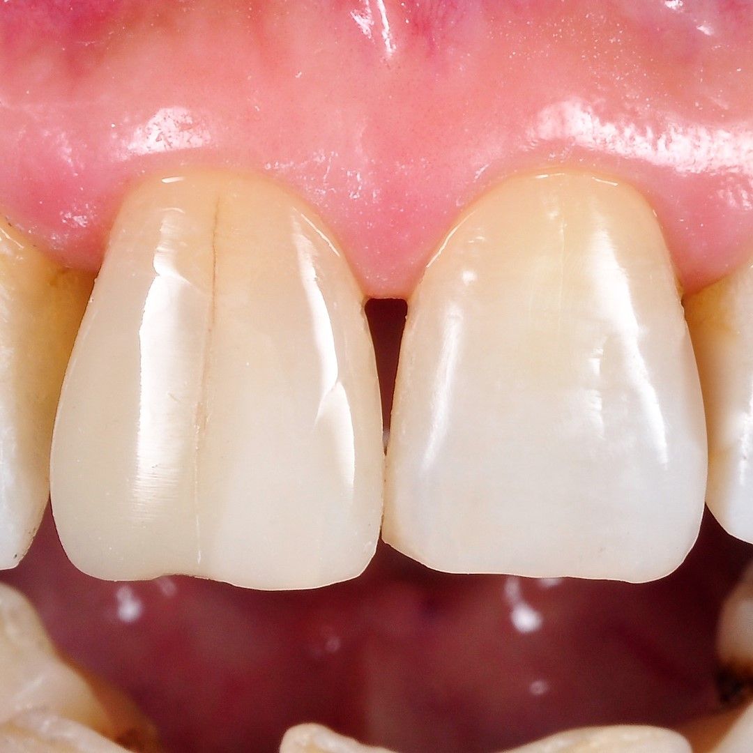 Front Teeth Repair of Grinding Fractures after