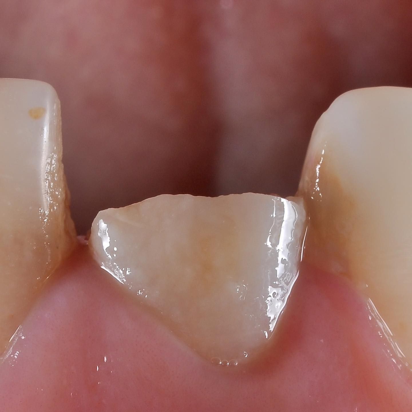Front Teeth Repair of Grinding Fractures before