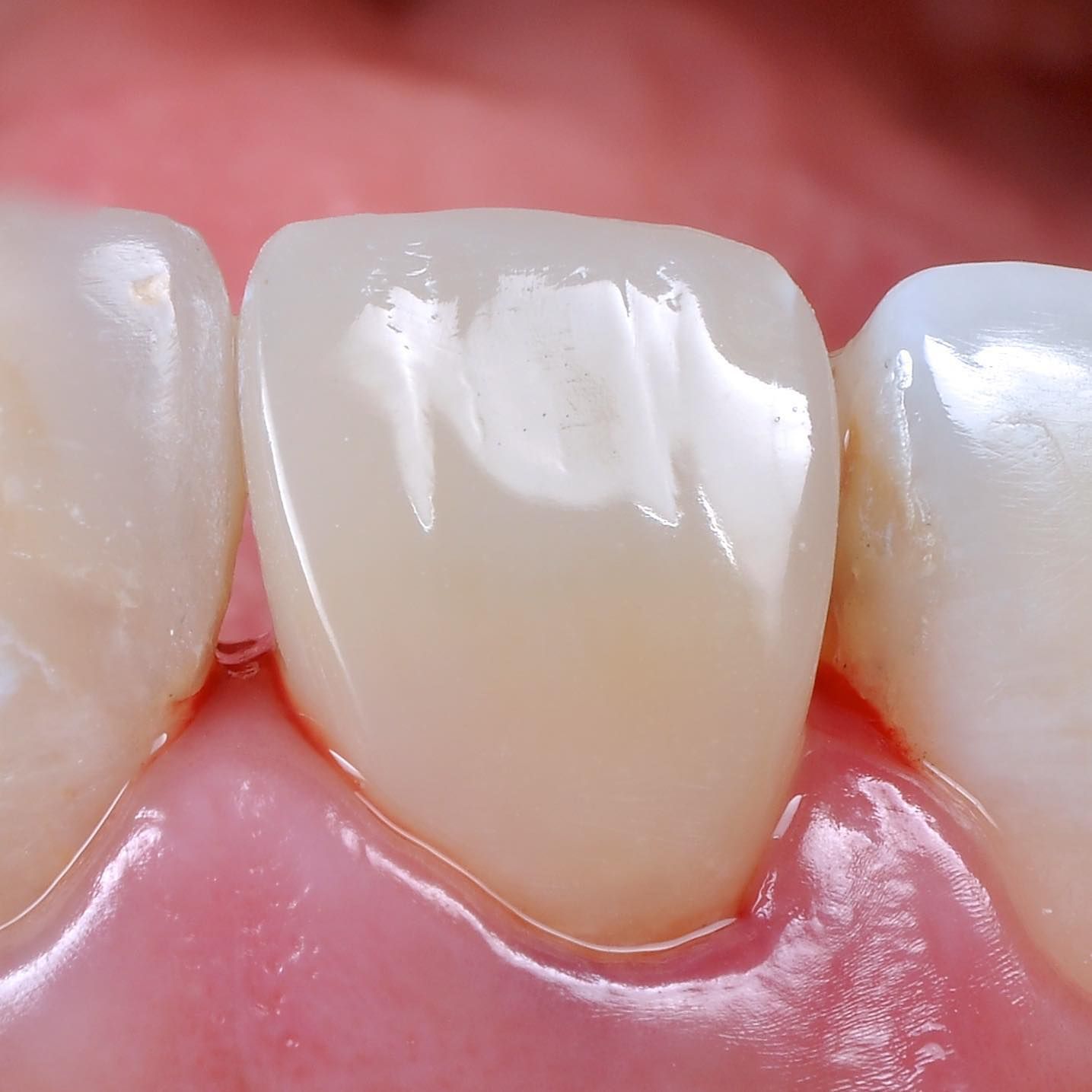 Front Teeth Repair of Grinding Fractures after