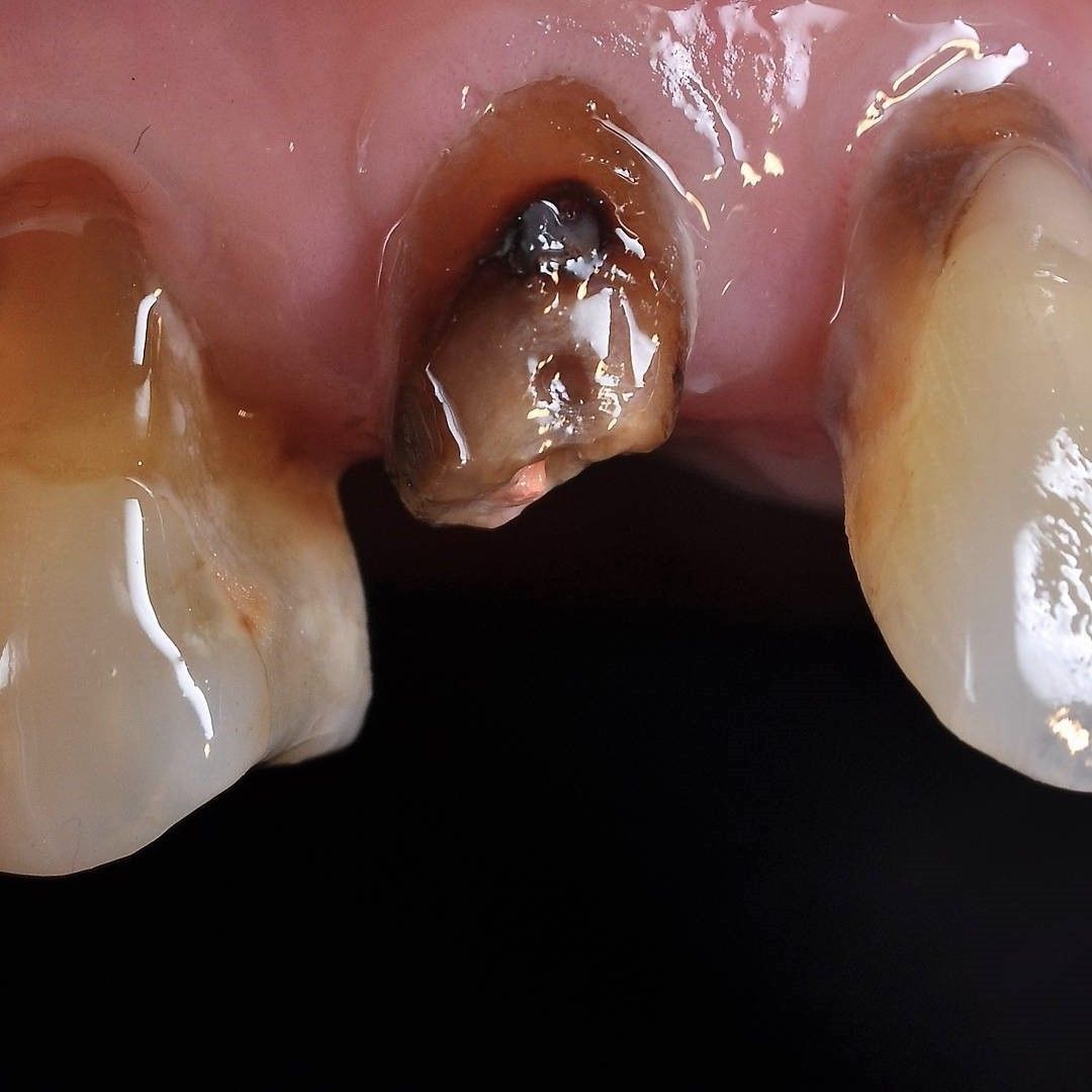 Front Teeth Repair of Grinding Fractures before
