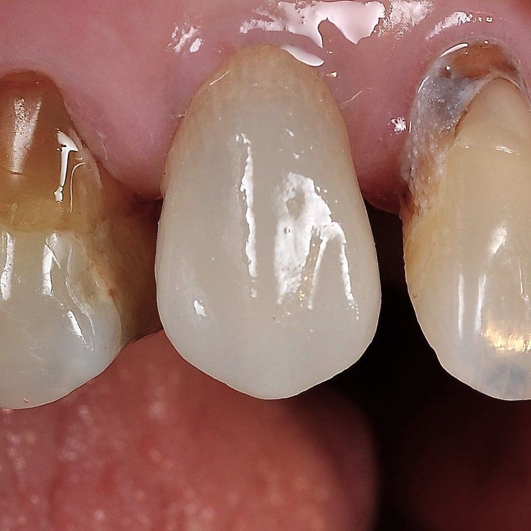Front Teeth Repair of Grinding Fractures after