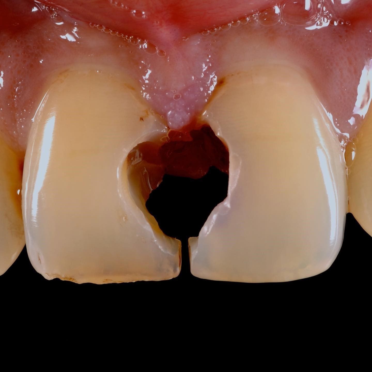 Front Tooth Filling Restoration before