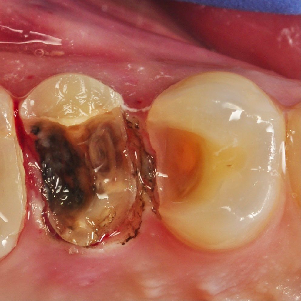 Back Teeth Repair of Grinding Fractures before