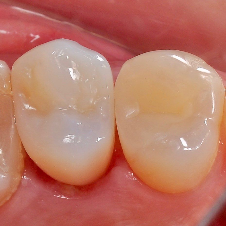 Back Teeth Repair of Grinding Fractures after