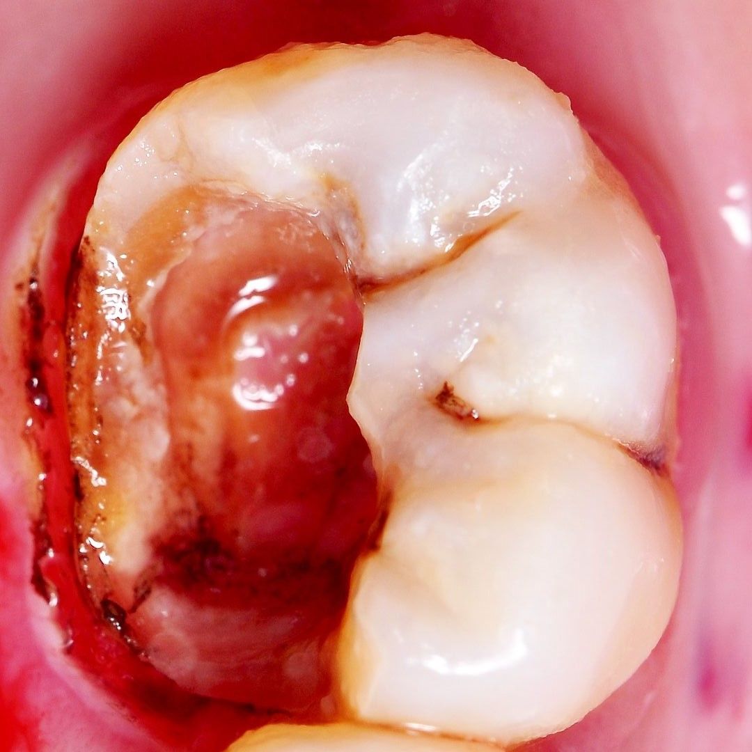 Back Teeth Repair of Grinding Fractures before