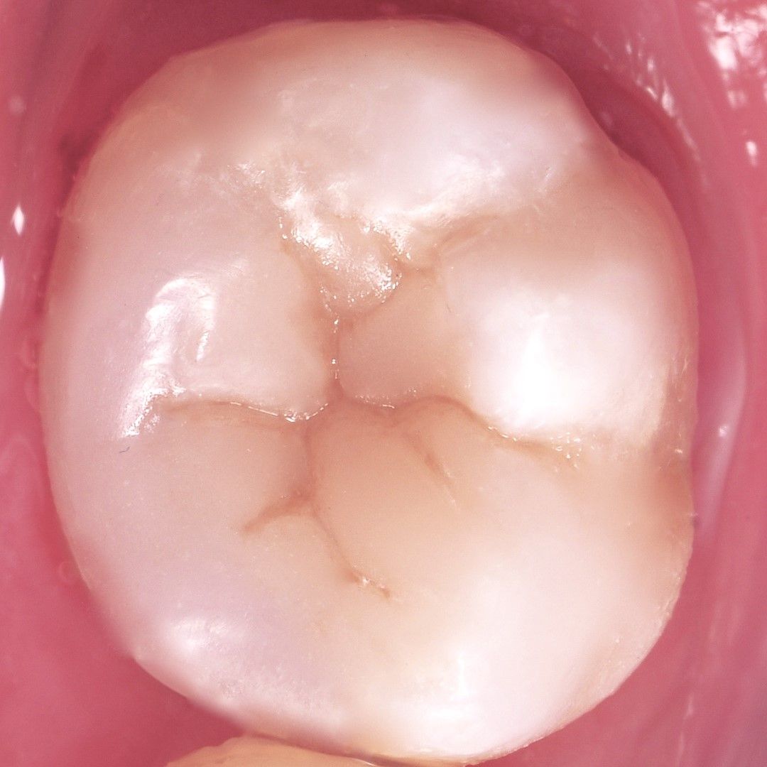 Back Teeth Repair of Grinding Fractures after