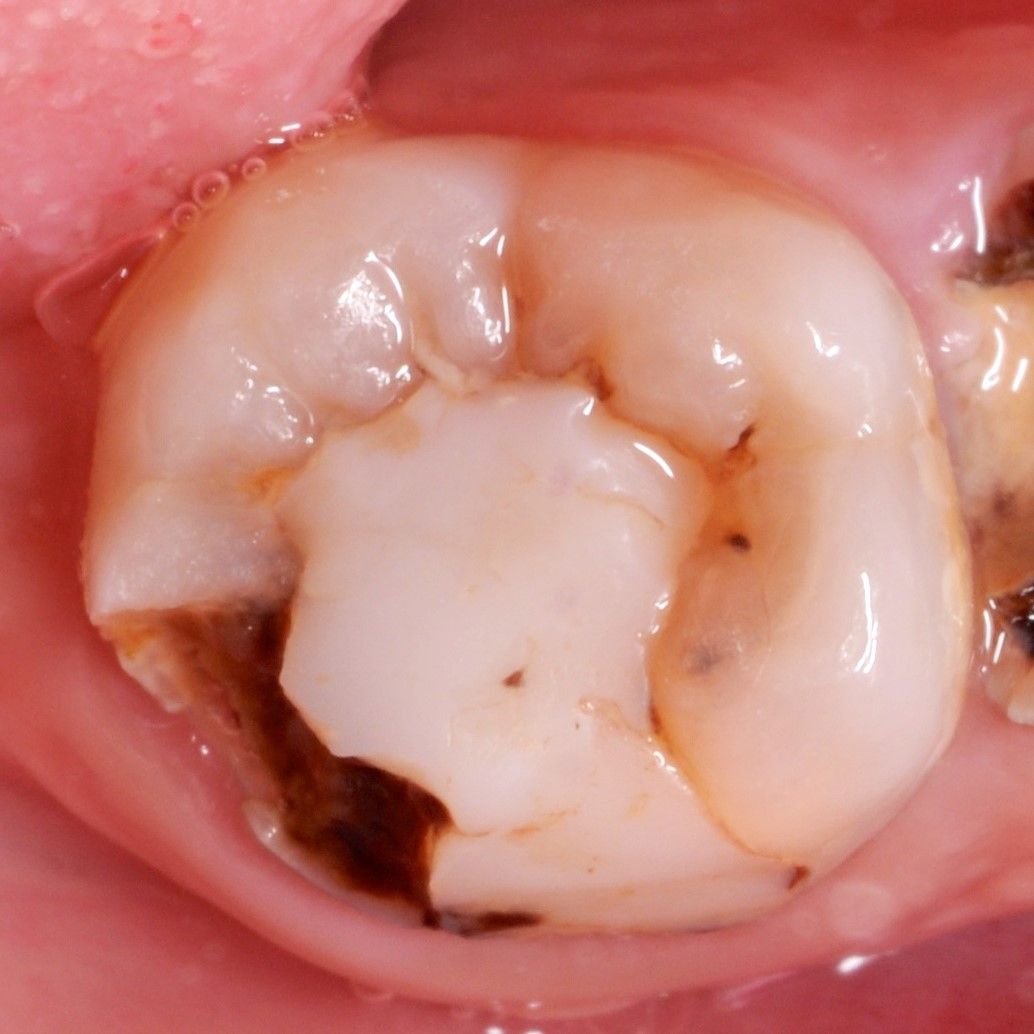 Back Teeth Repair of Grinding Fractures before