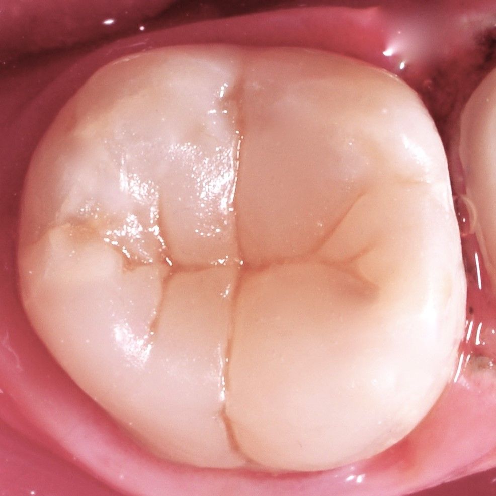 Back Teeth Repair of Grinding Fractures after