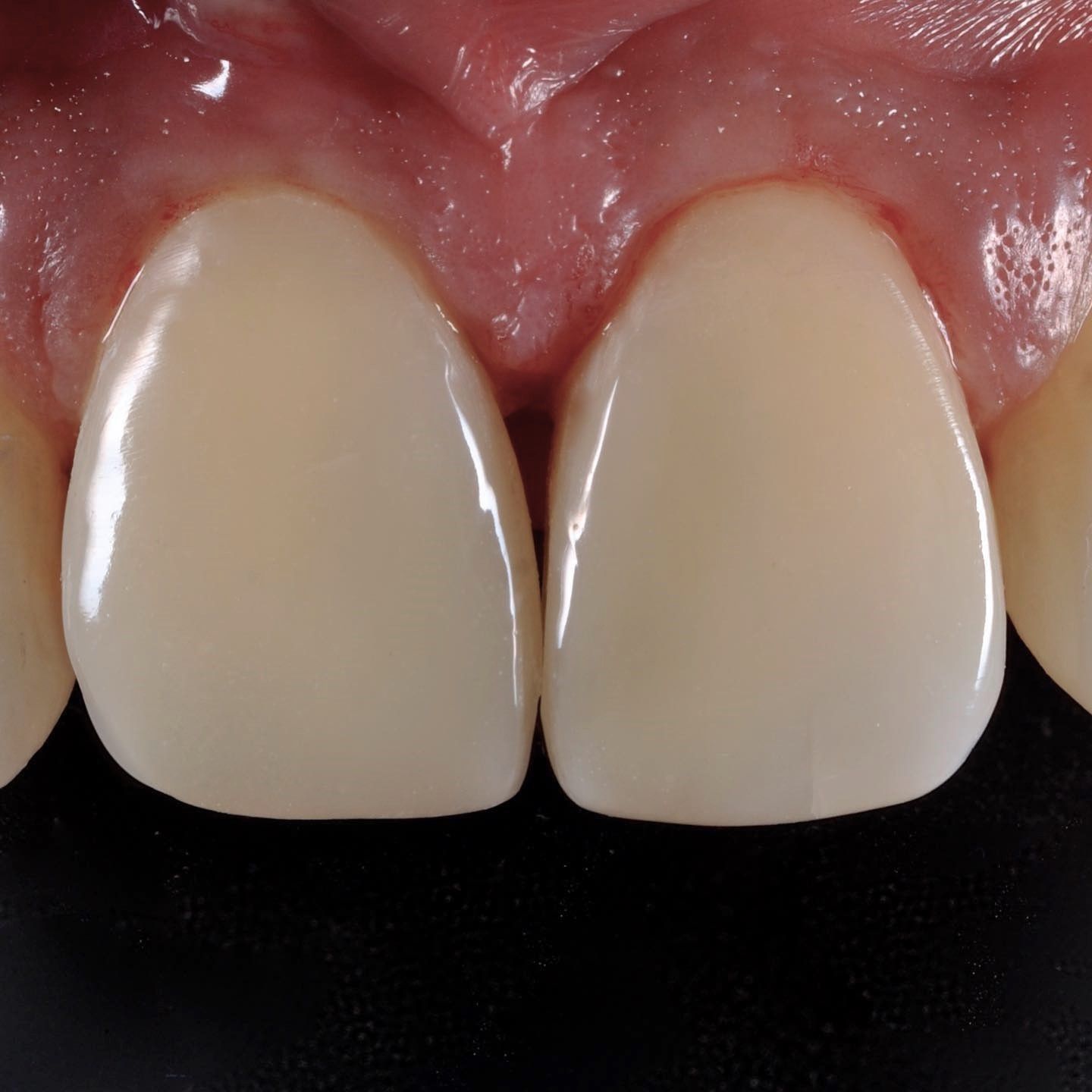 Front Tooth Filling Restoration after