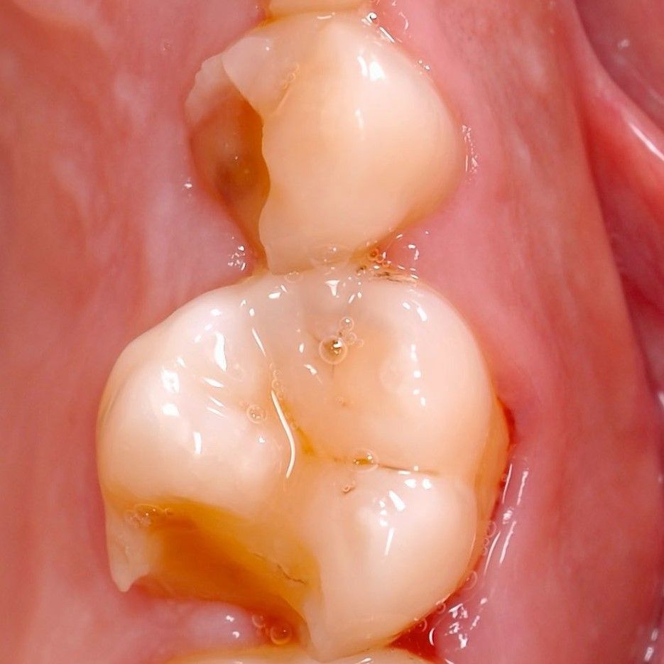 Broken Teeth Restoration before