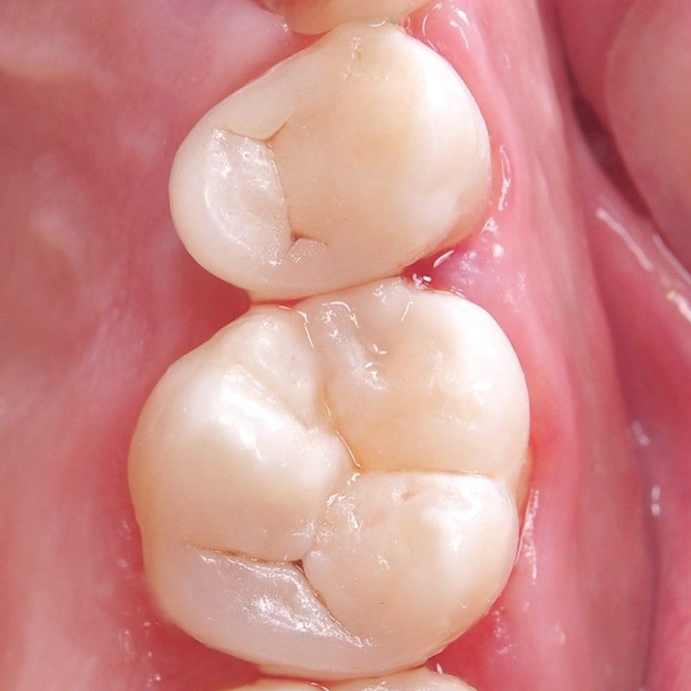Broken Teeth Restoration after