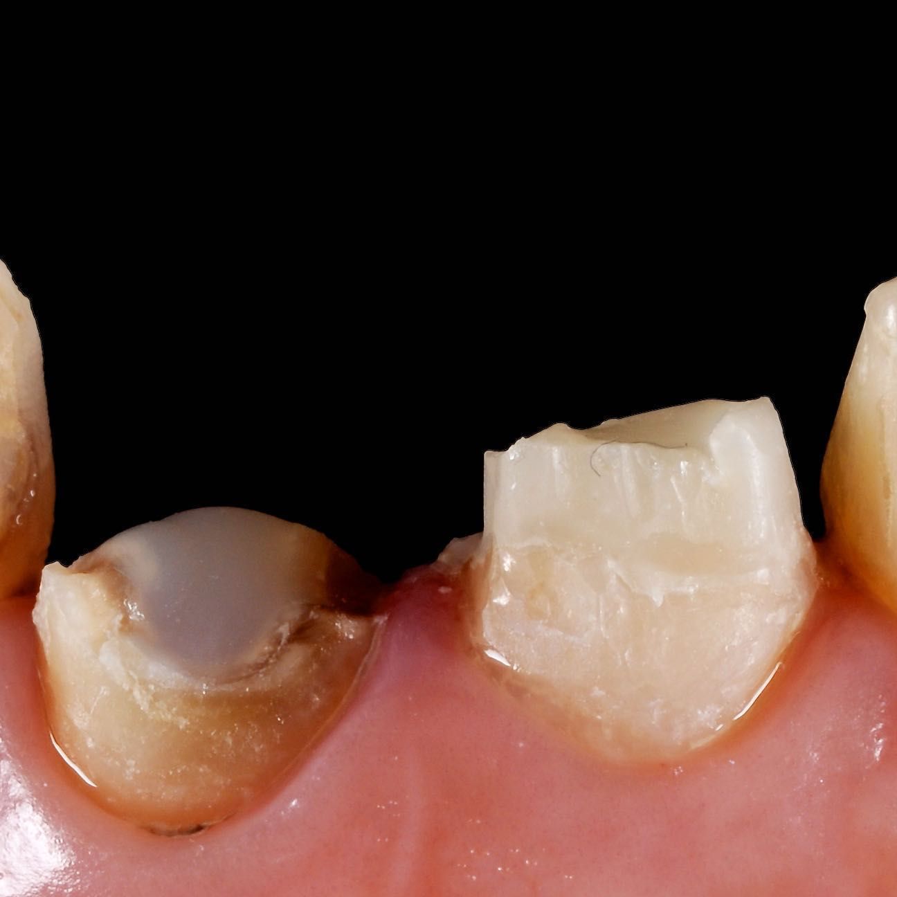 Broken Tooth Repair before