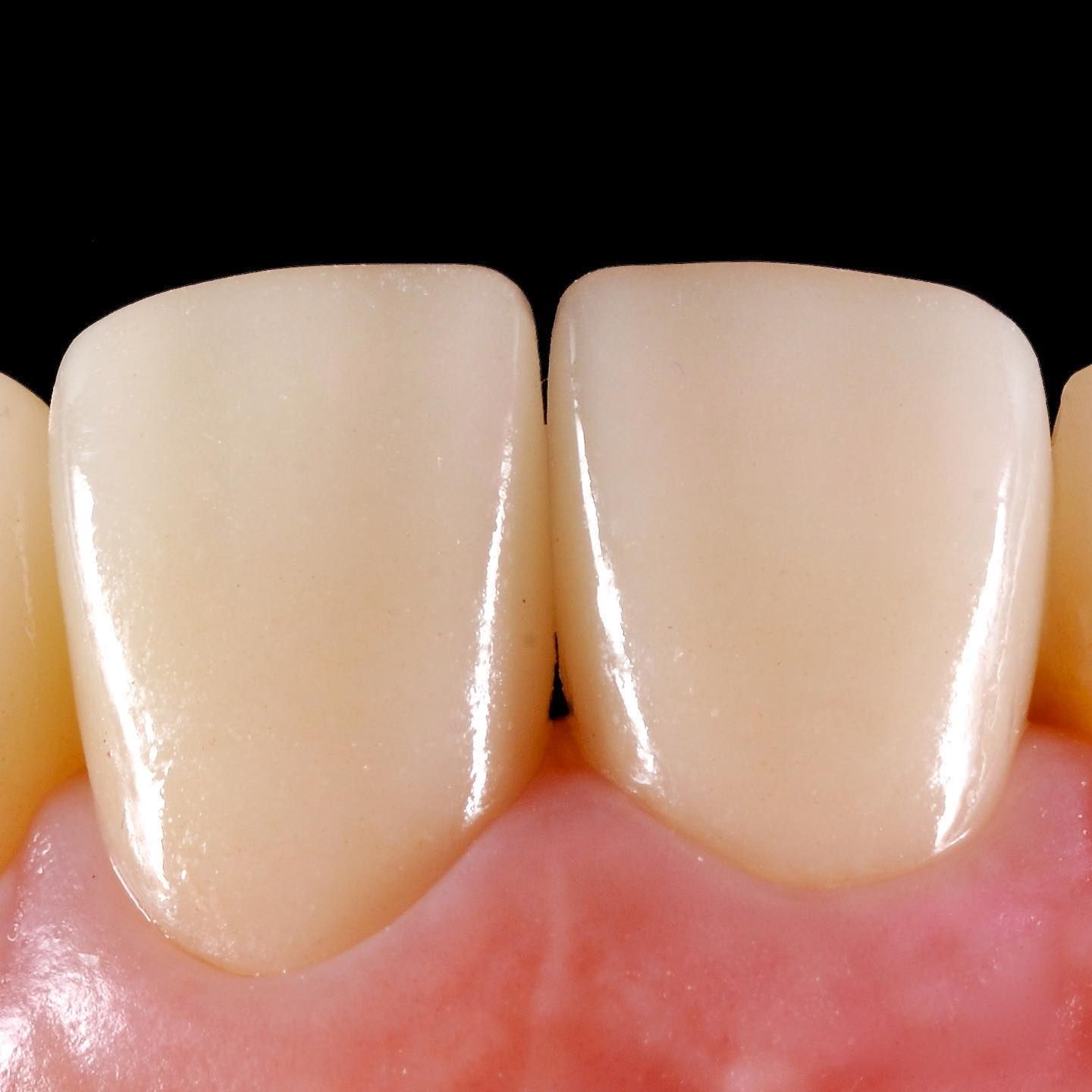 Broken Tooth Repair after