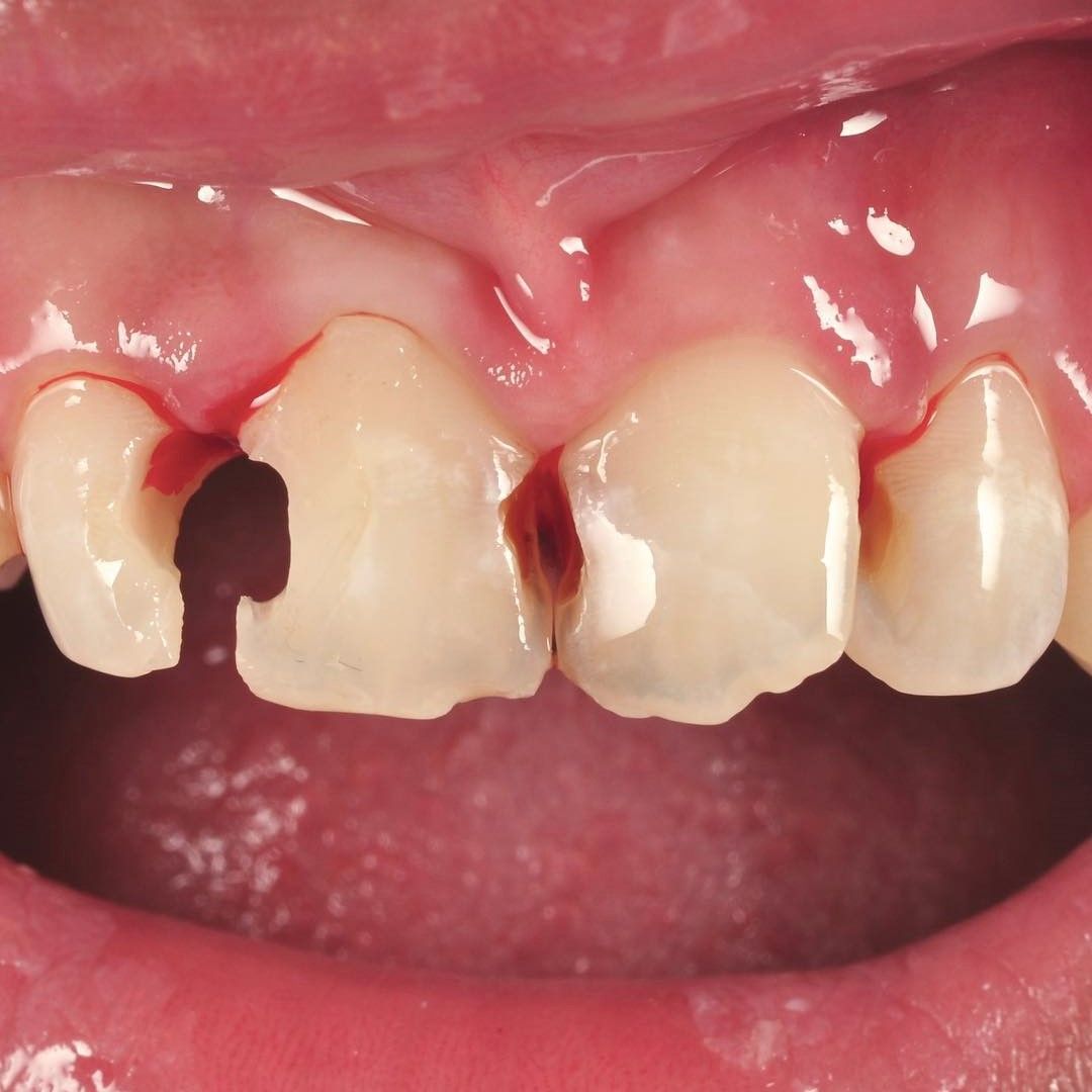 Cavity Makeover before