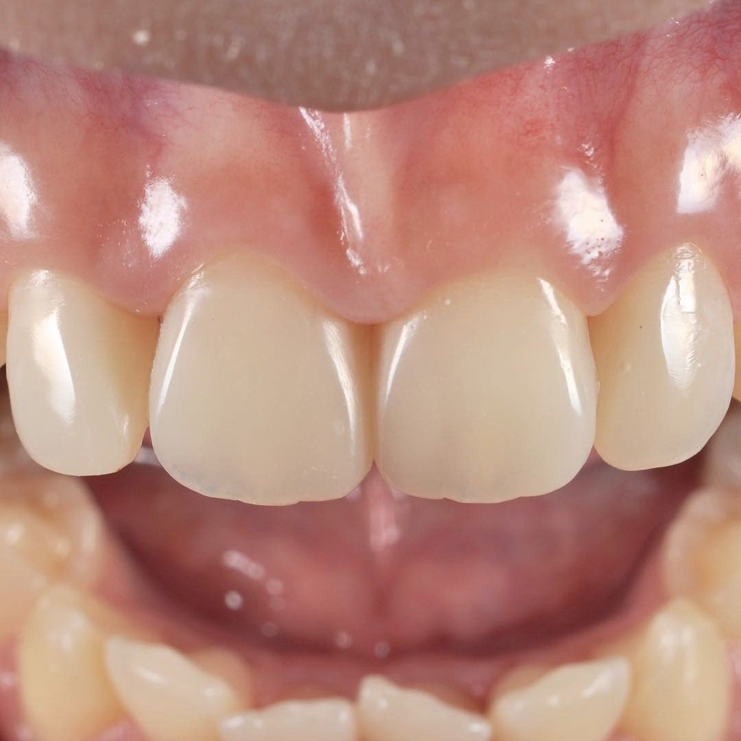 Cavity Makeover after