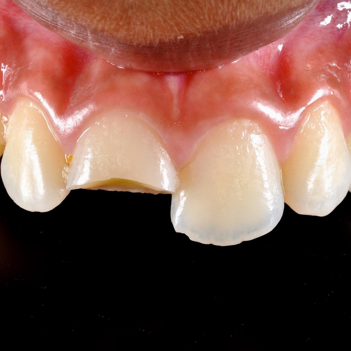 Child's Broken Tooth Repair before