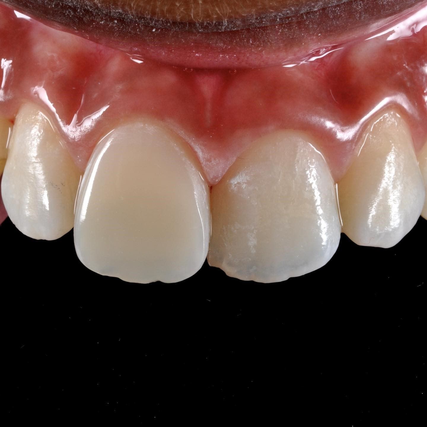 Child's Broken Tooth Repair after