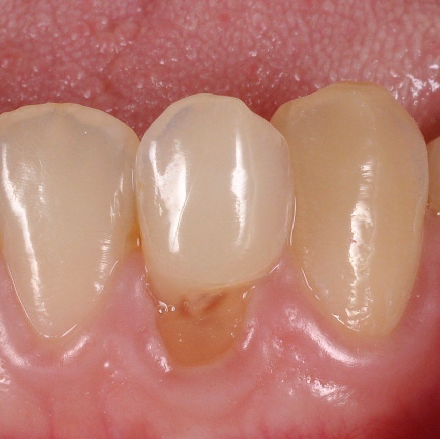 Covering Exposed Roots before