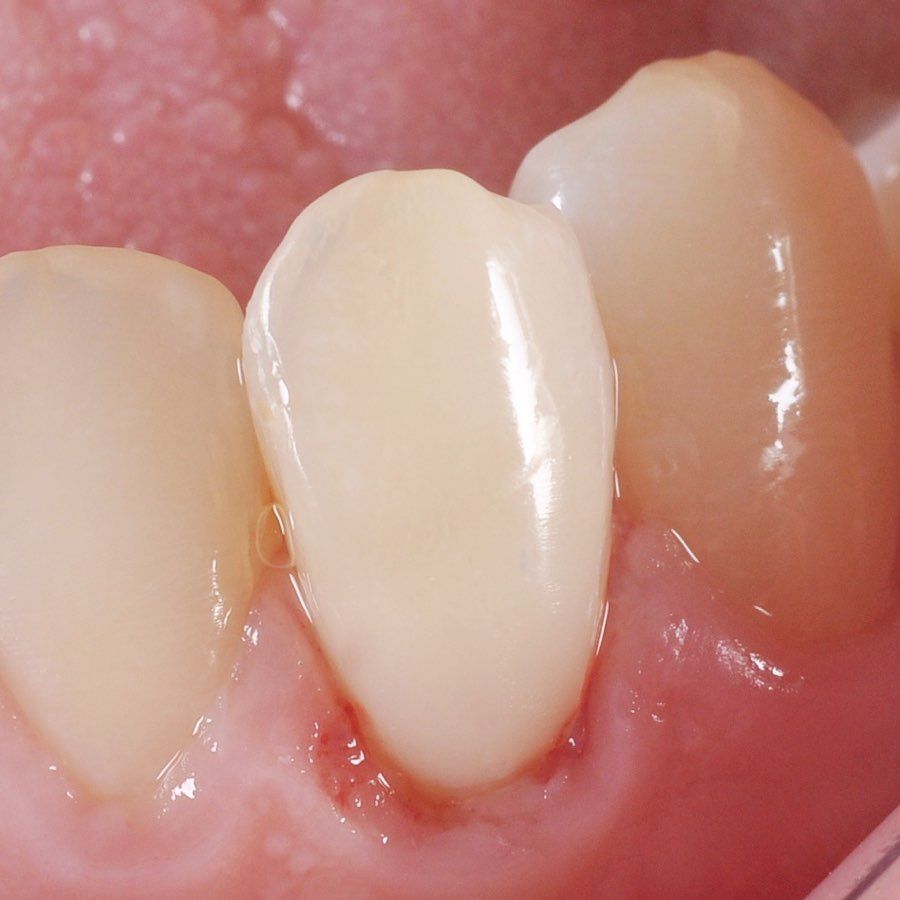 Covering Exposed Roots after