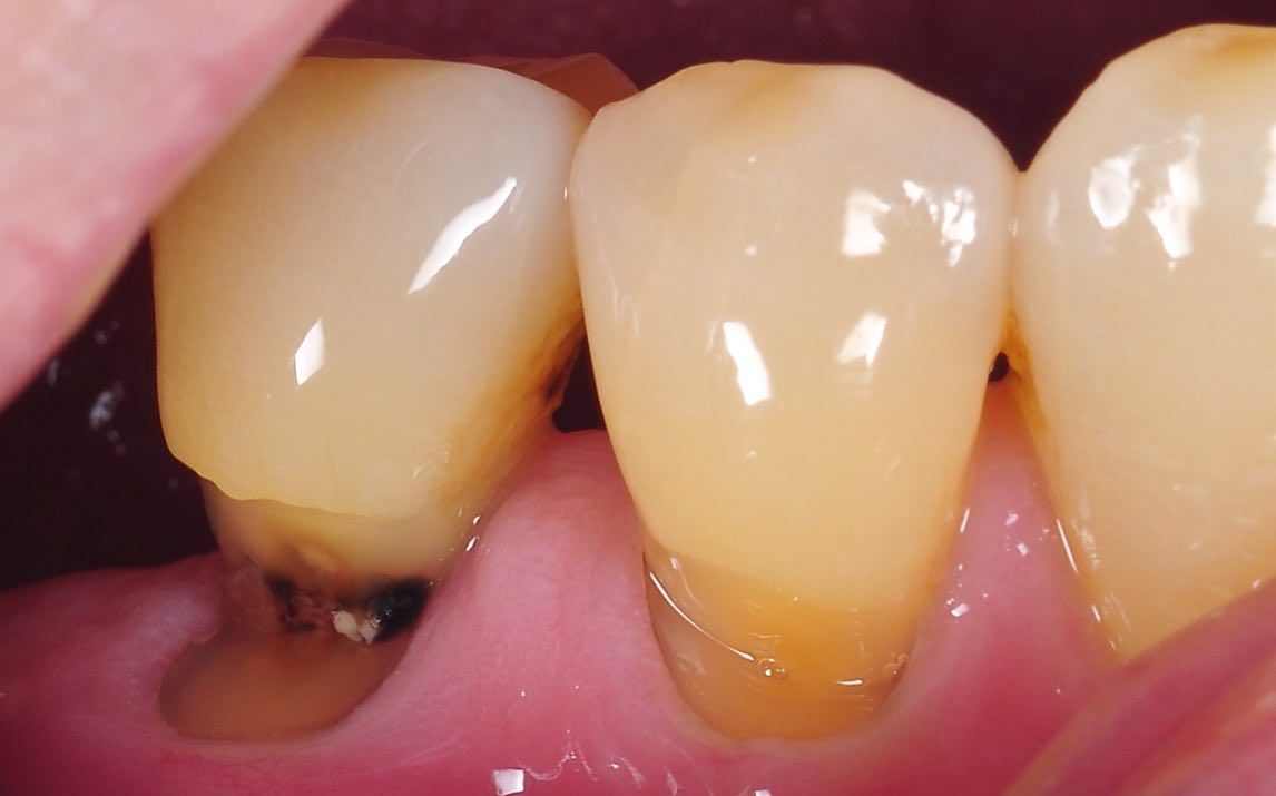 Covering Recession before