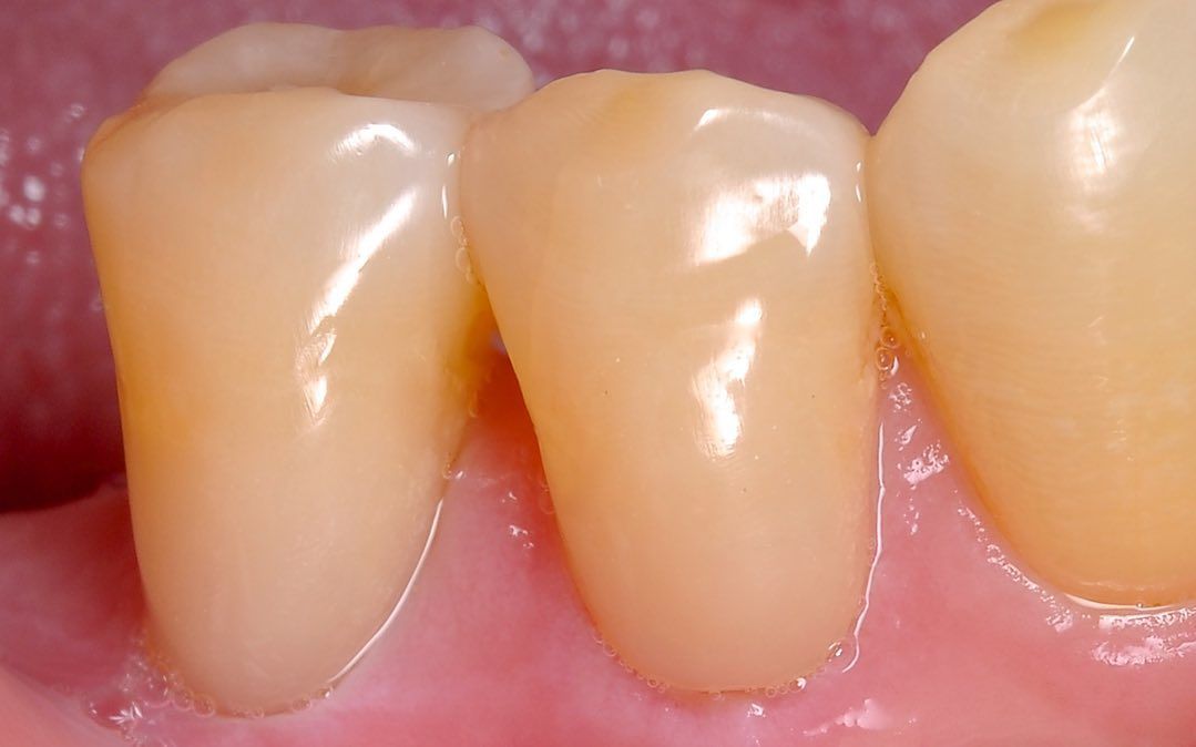 Covering Recession after