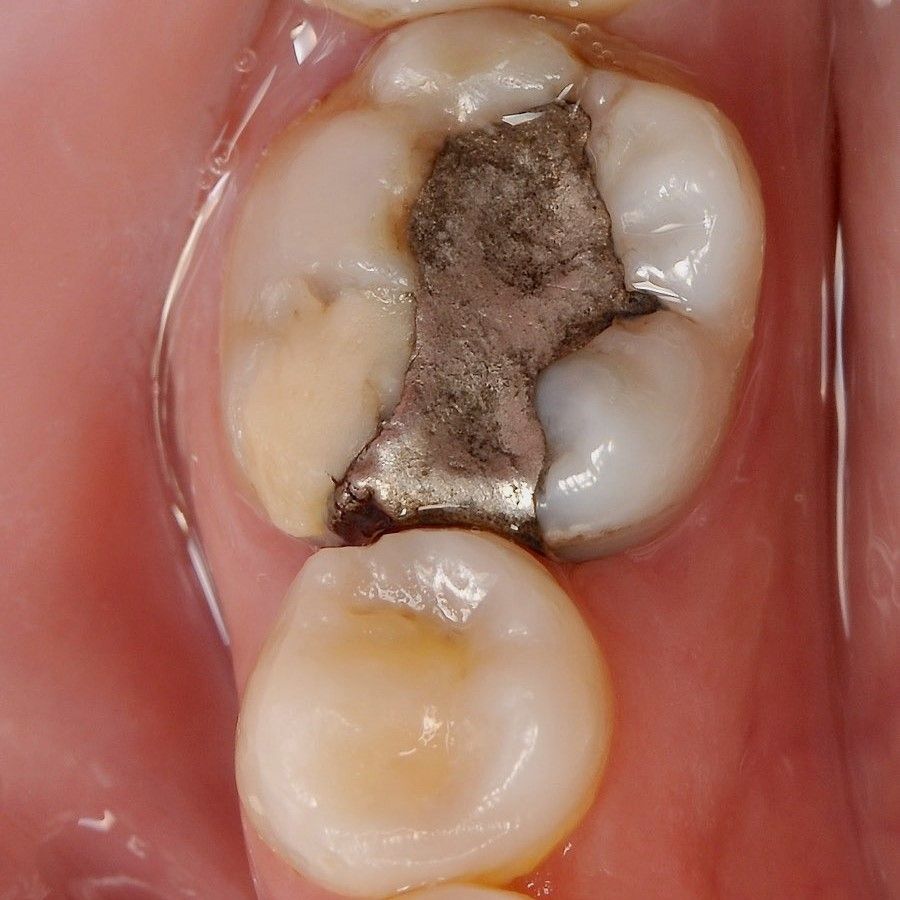 Back Tooth Filling Restoration before