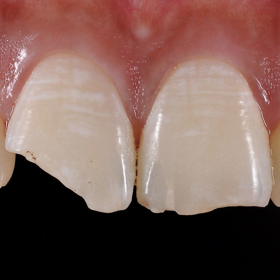 Front Teeth Rejuvenation before