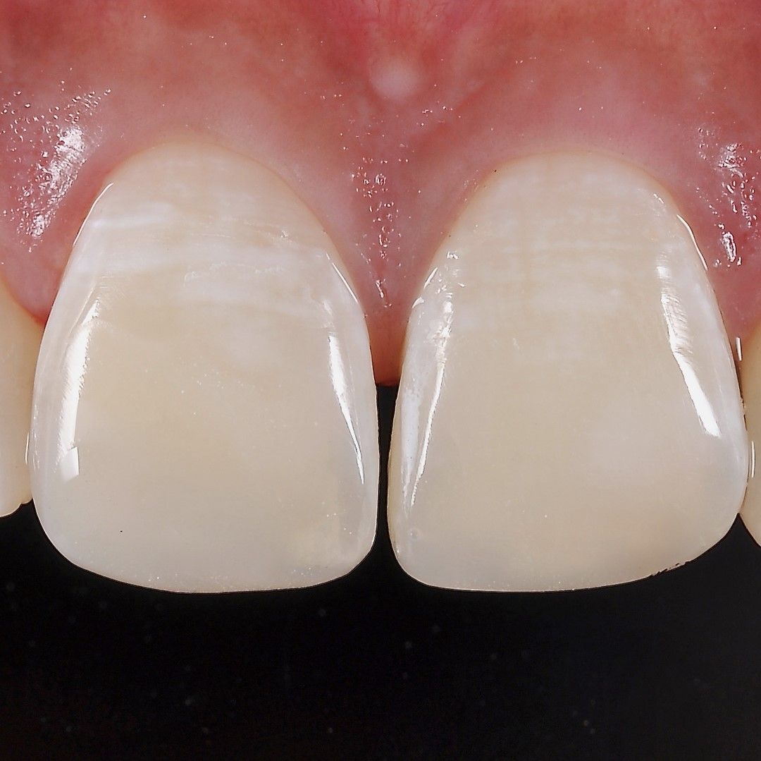 Front Teeth Rejuvenation after