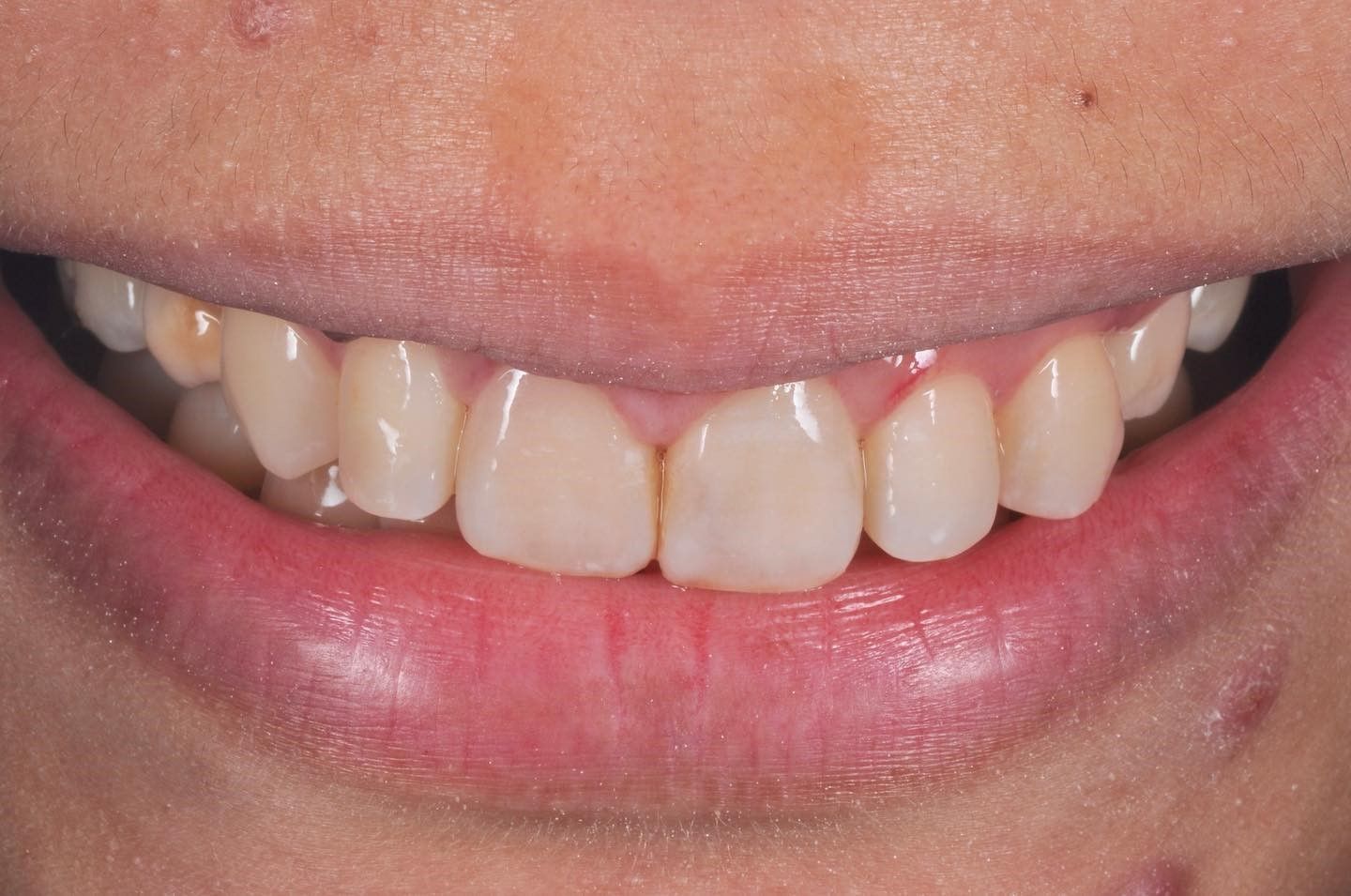 Smile Makeover before