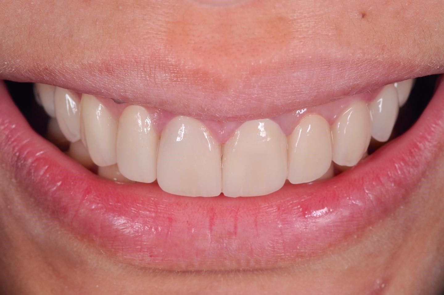 Smile Makeover after