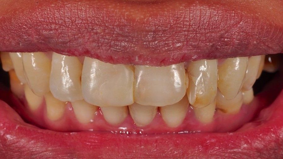 Smile Makeover before