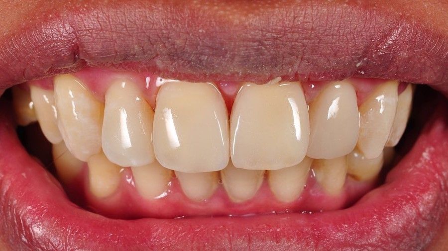 Smile Makeover after