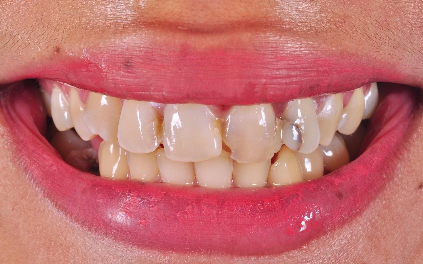 Smile Makeover before