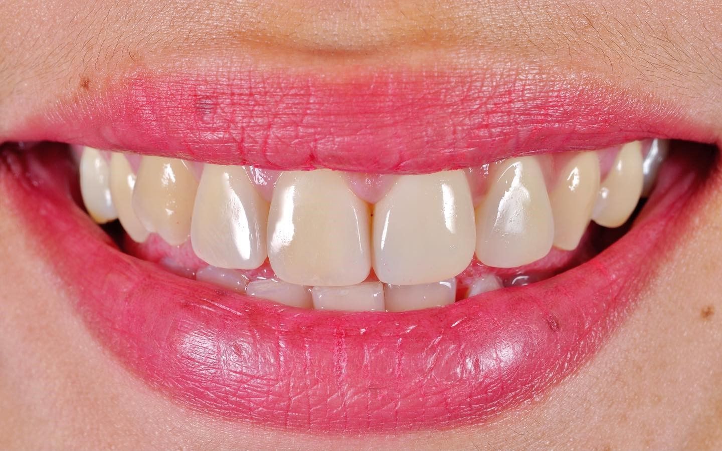 Smile Makeover after