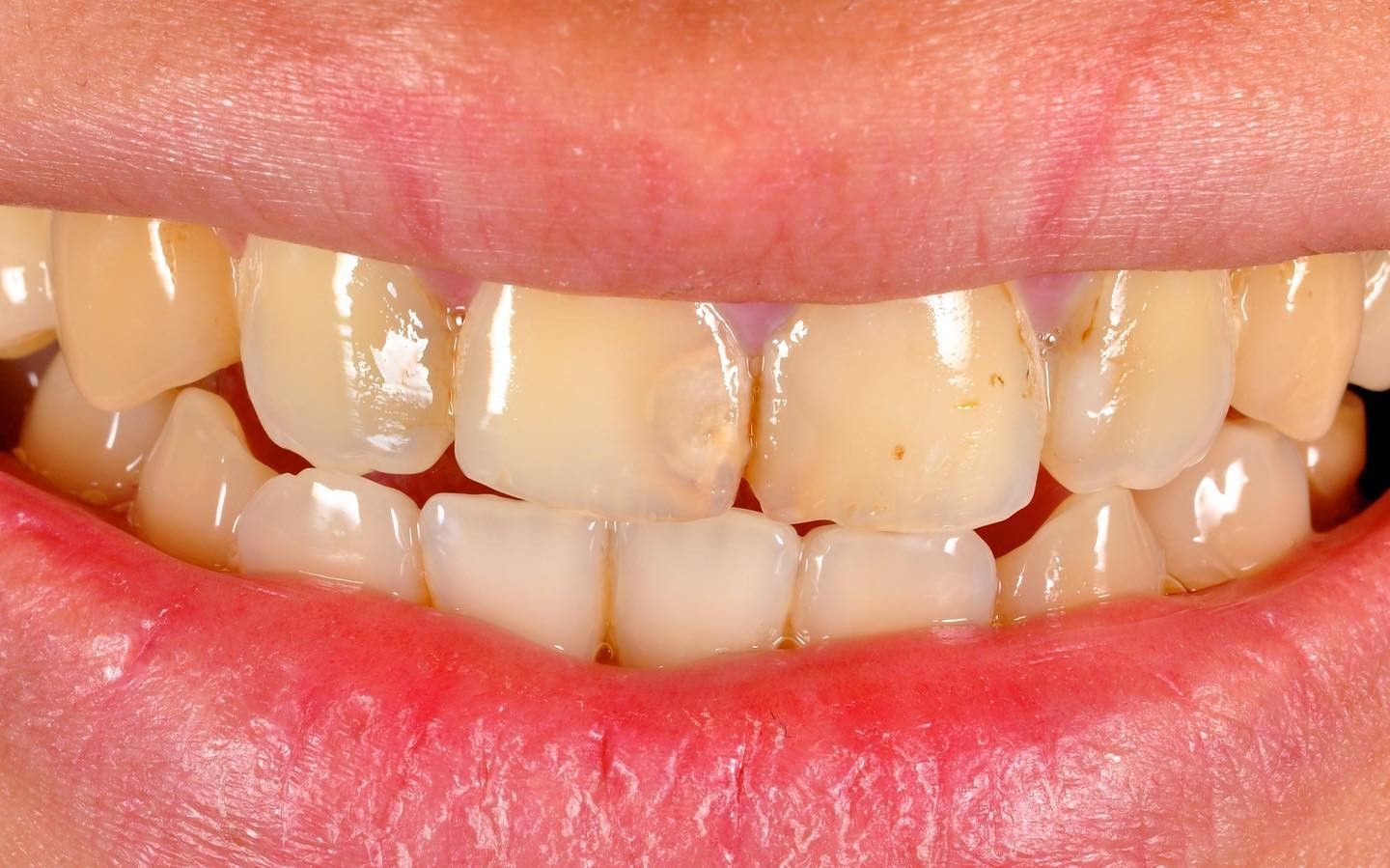 Smile Makeover before