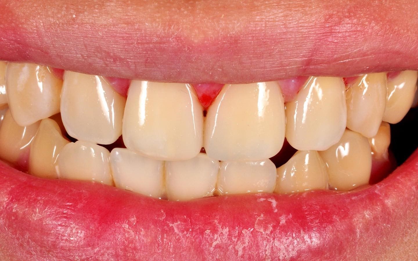 Smile Makeover after