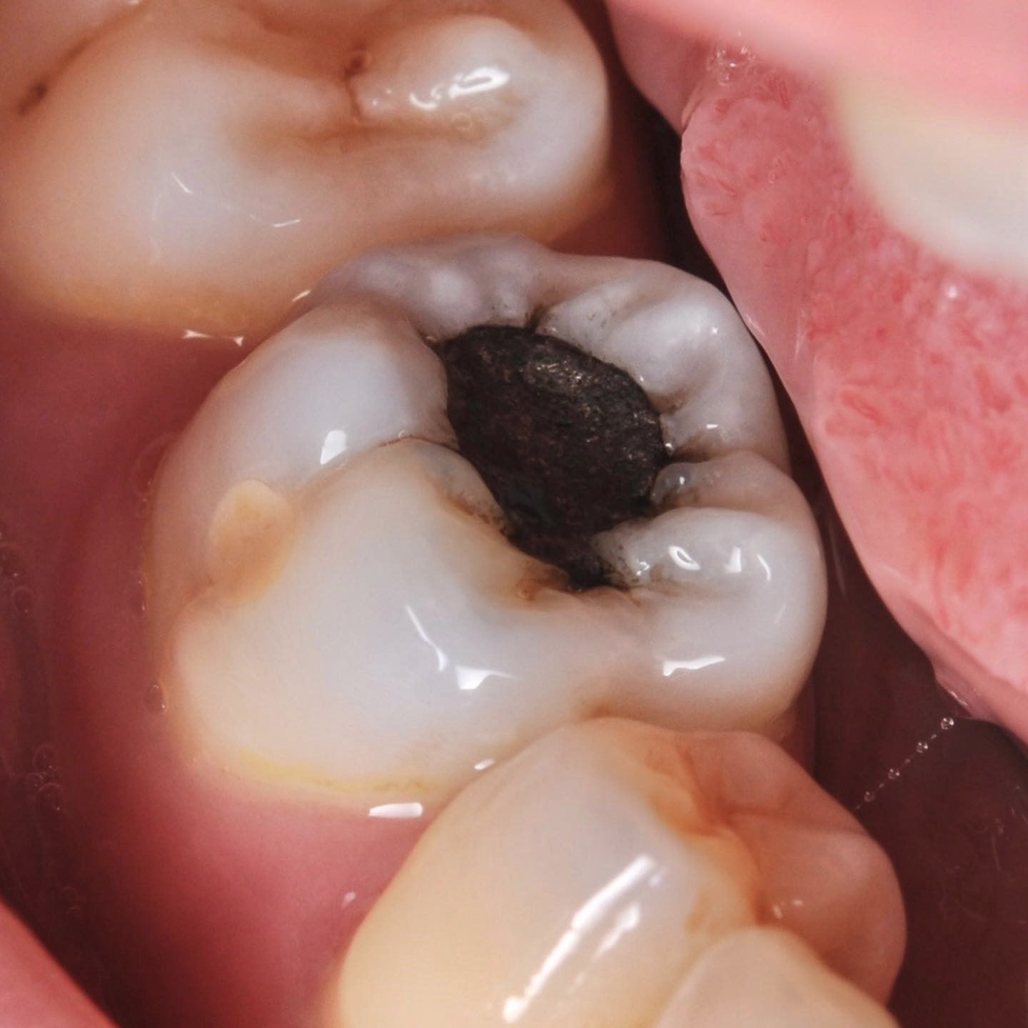 Mercury Removal before