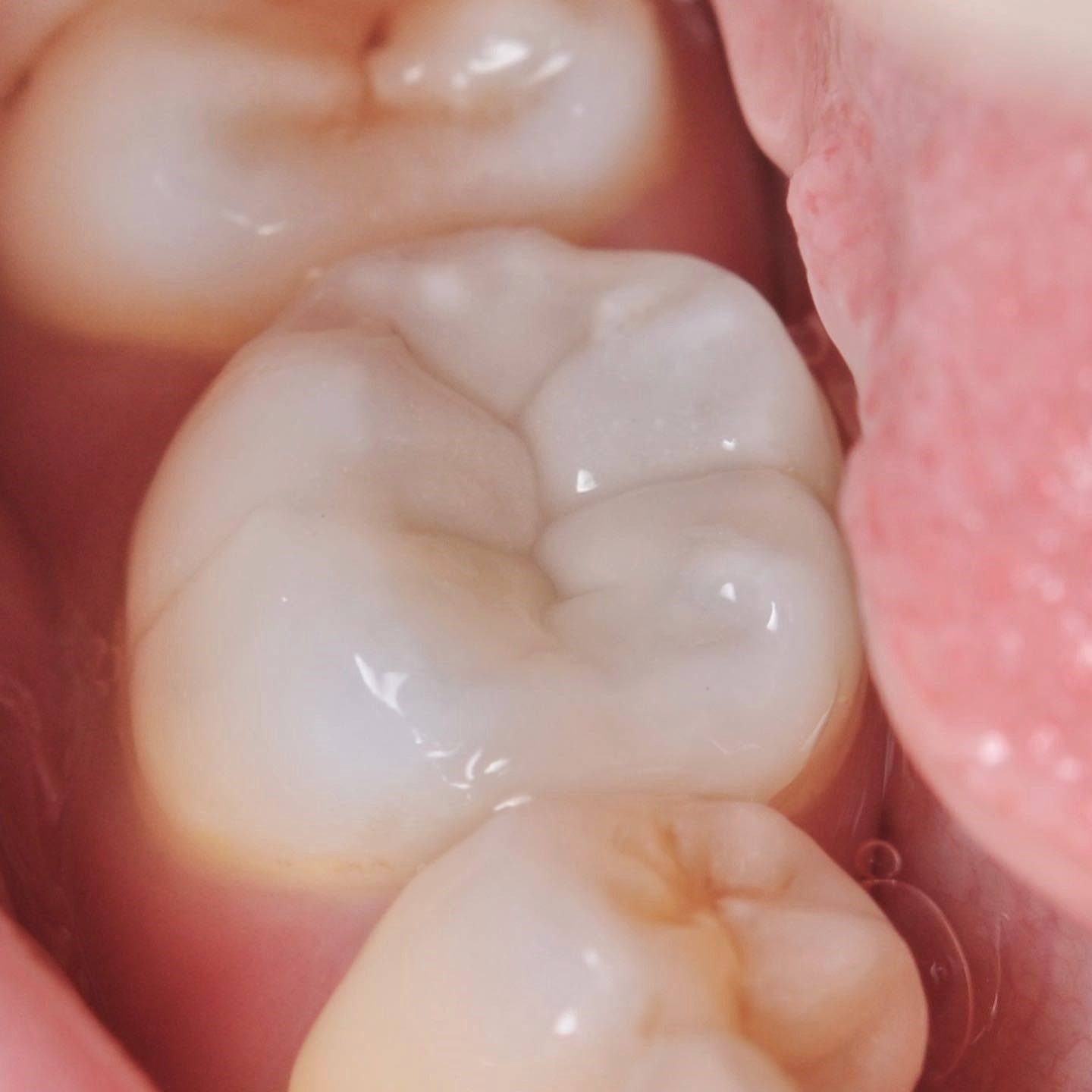 Mercury Removal after