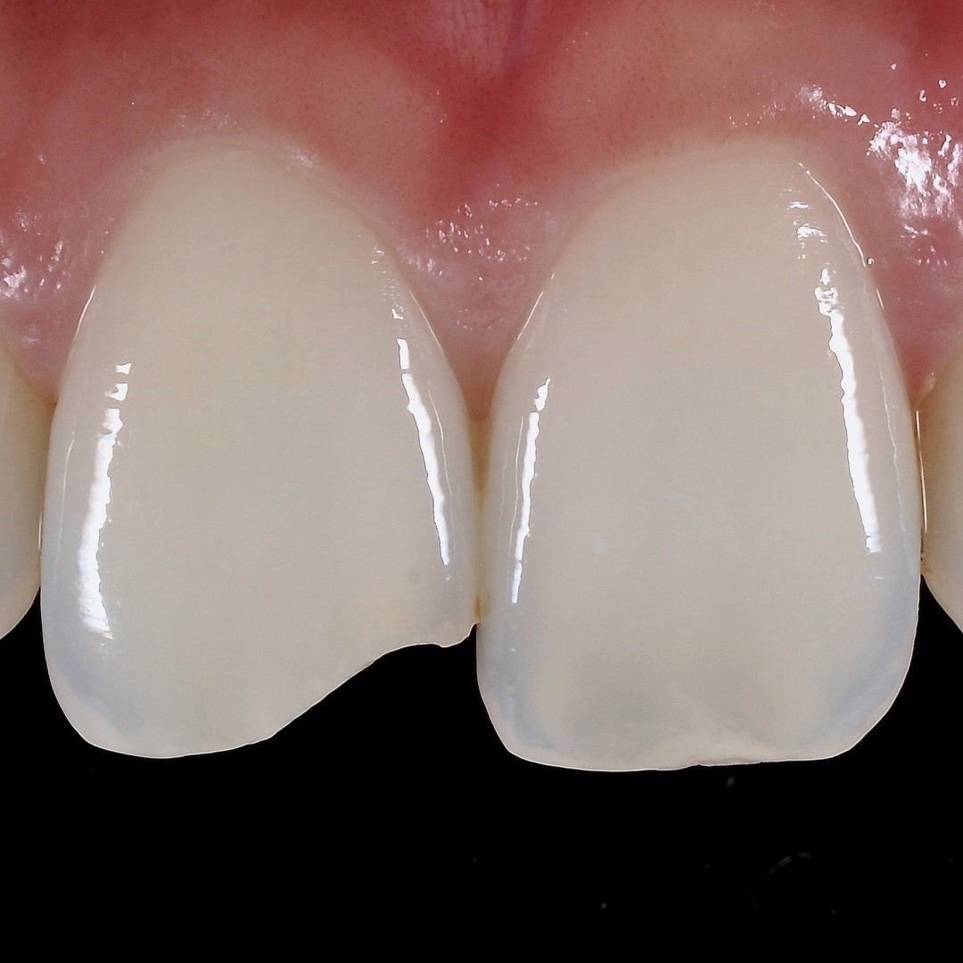 Front Tooth Restoration before