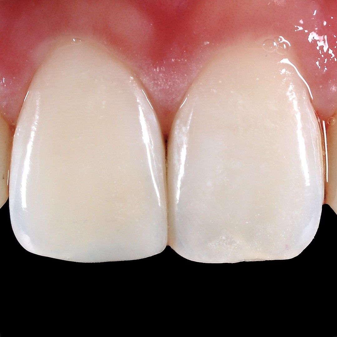 Front Tooth Restoration after
