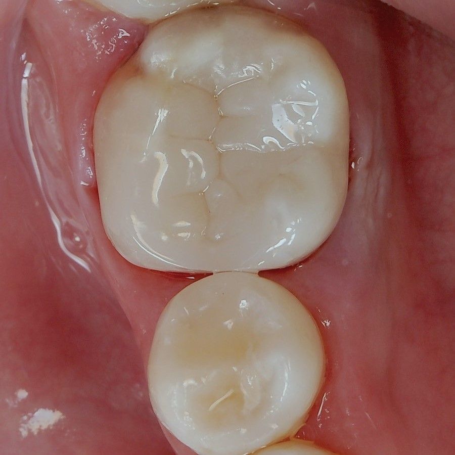 Back Tooth Filling Restoration after