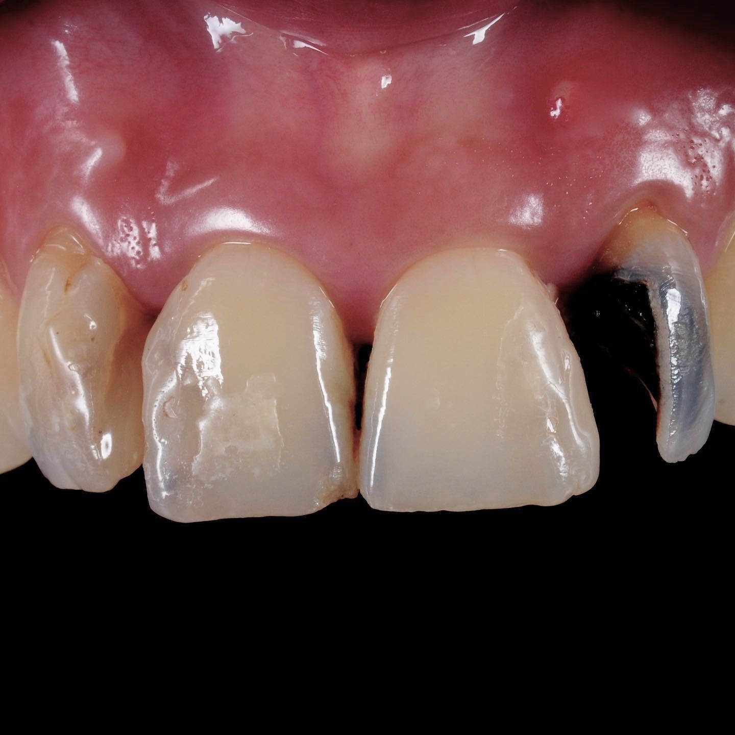 Teeth Makeover before