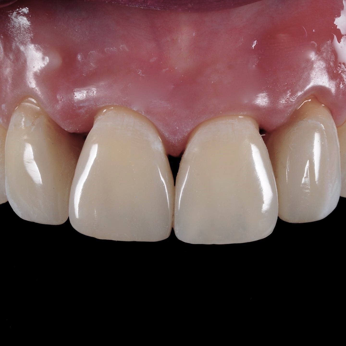 Teeth Makeover after