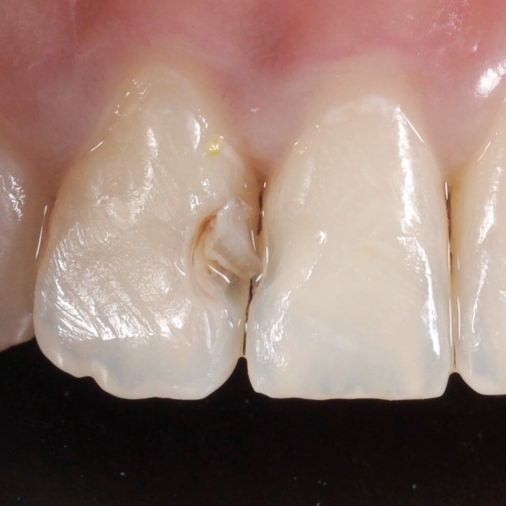 Tooth Rejuvenation before