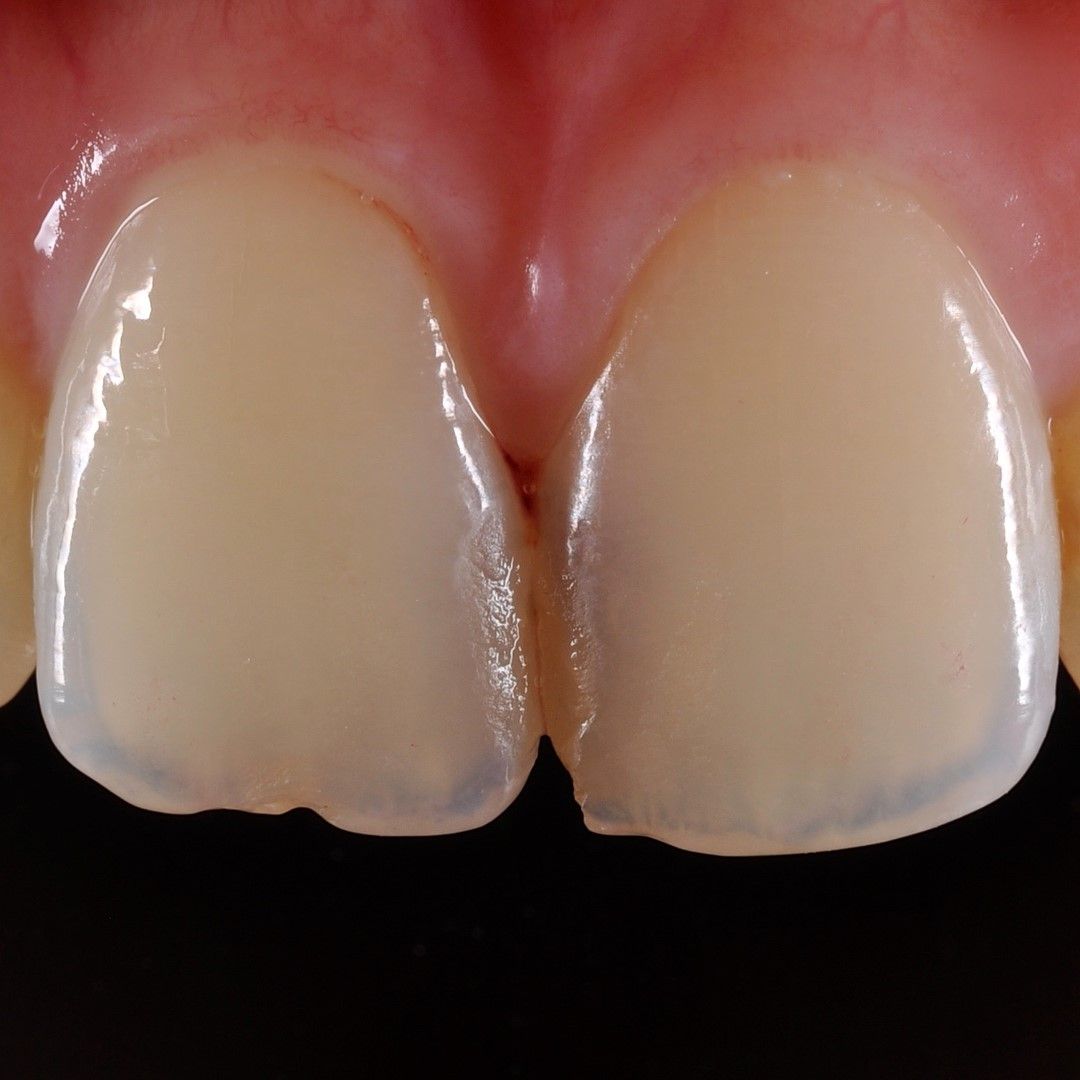 Worn Down Chipped Tooth before