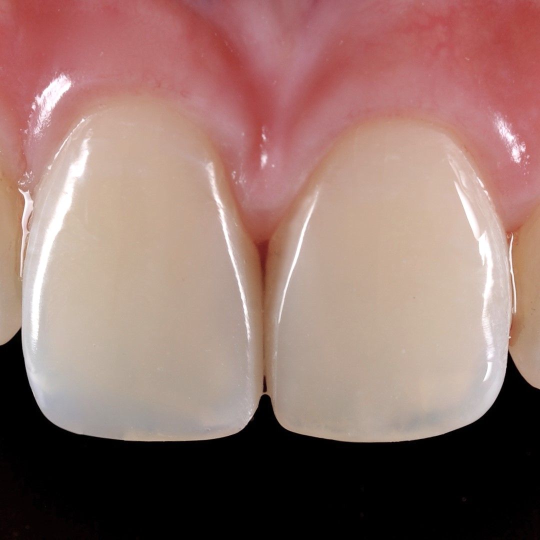 Worn Down Chipped Tooth after