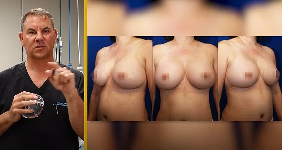 Surgeon explaining breast augmentation process and results.