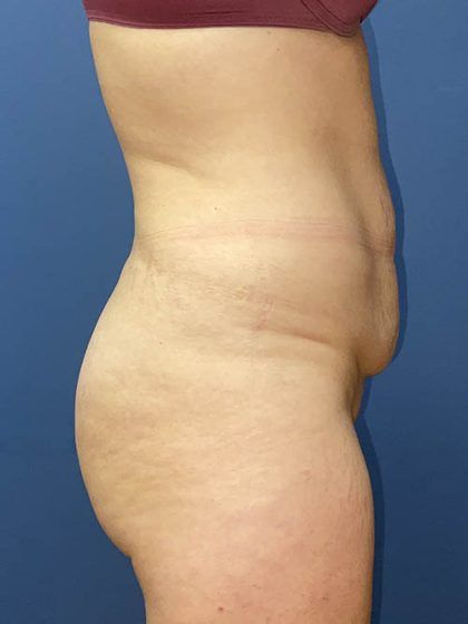 Tummy Tuck Before & After
