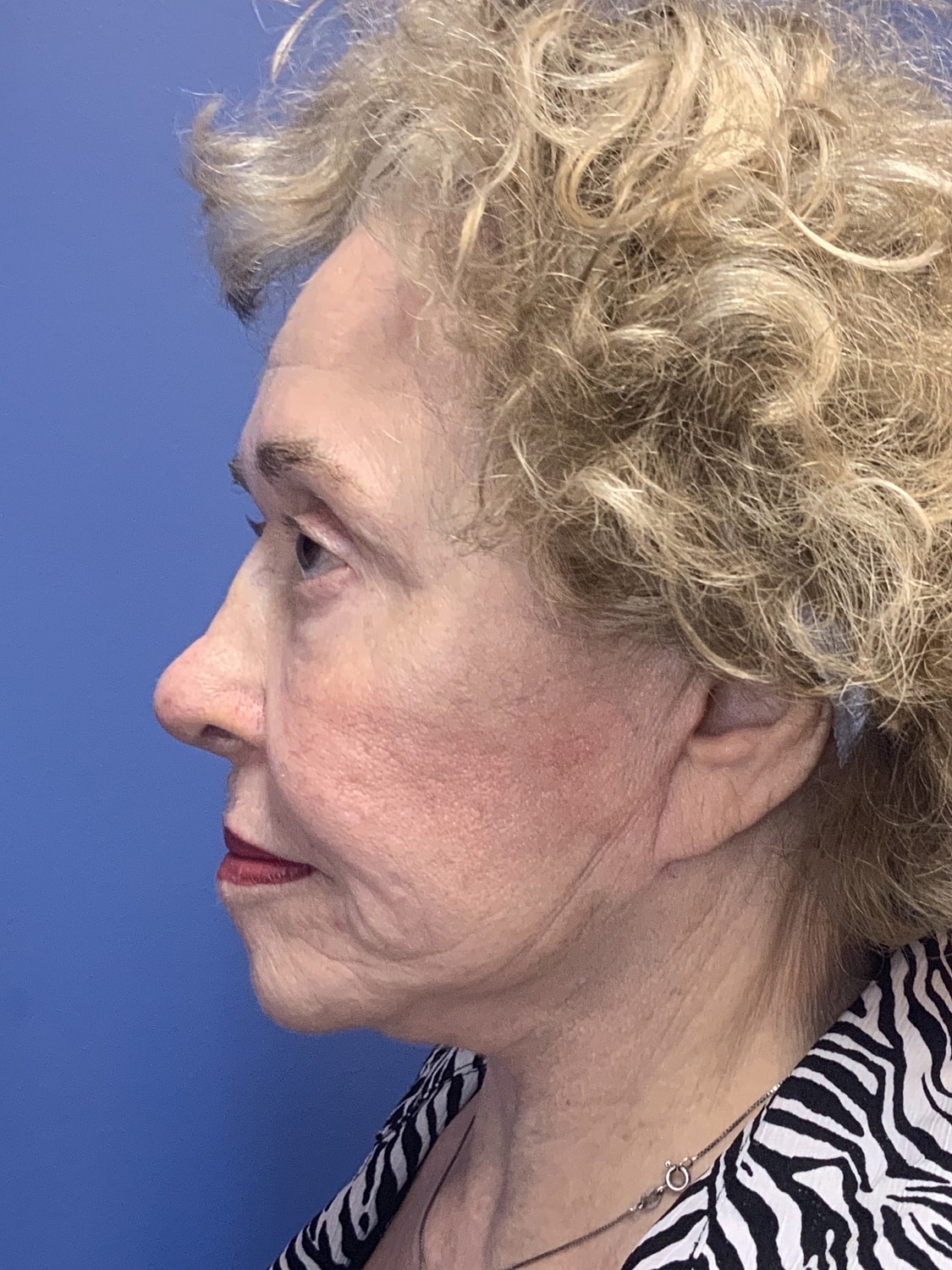 Facelift Before & After