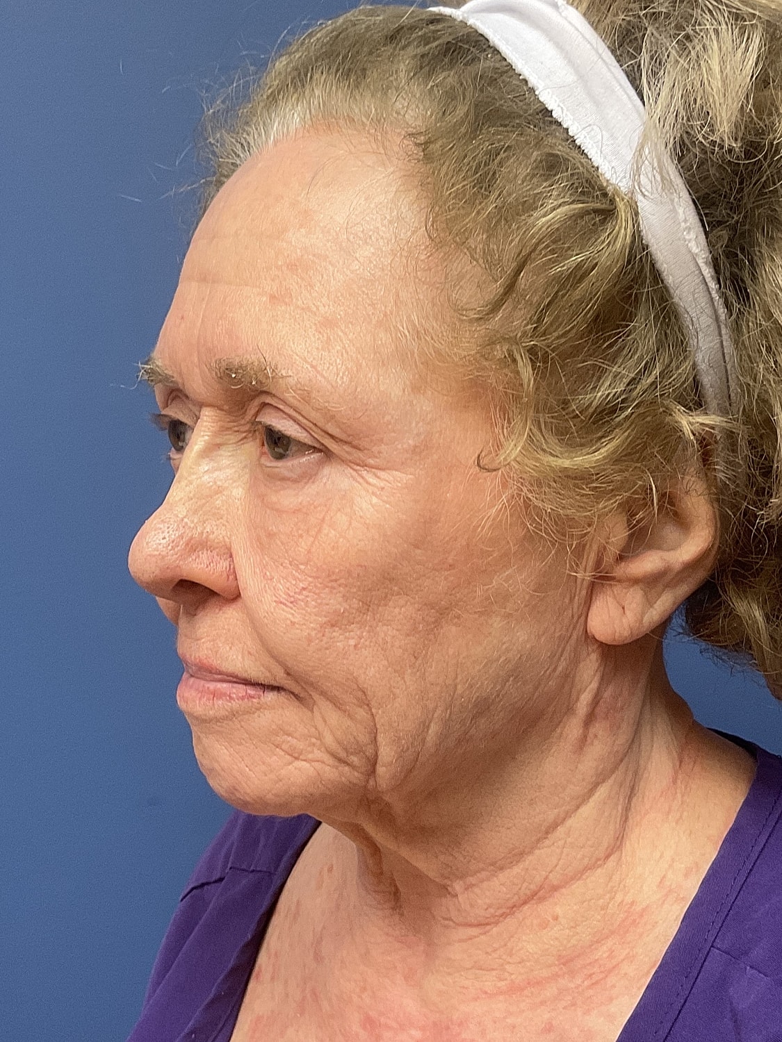 Facelift Before & After